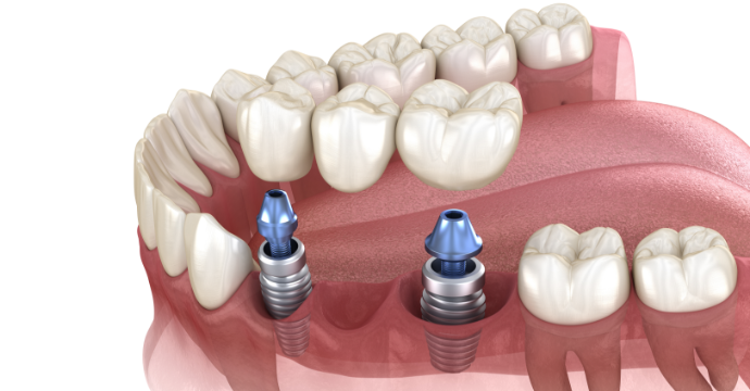 DENTAL IMPLANTS: TYPES AND HOW TO – Fairywill